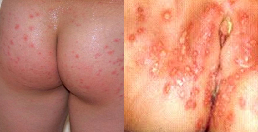 Genital herpes, additionally generally called “herpes,”...