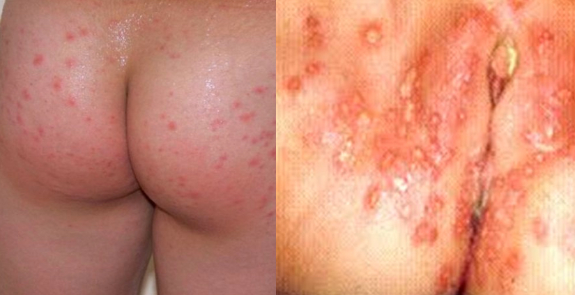 Genital Herpes - ROY HEALTH & SPECIALITY CLINIC